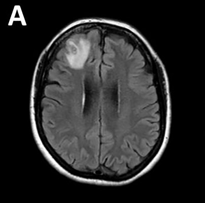 Un gusano redondo parásito que normalmente se encuentra en las serpientes ha sido extraído vivo y retorciéndose del cerebro de una mujer. Un gusano redondo parásito que normalmente se encuentra en las serpientes ha sido extraído vivo y retorciéndose del cerebro de una mujer.
