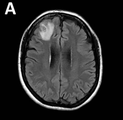 Un gusano redondo parásito que normalmente se encuentra en las serpientes ha sido extraído vivo y retorciéndose del cerebro de una mujer. Un gusano redondo parásito que normalmente se encuentra en las serpientes ha sido extraído vivo y retorciéndose del cerebro de una mujer.
