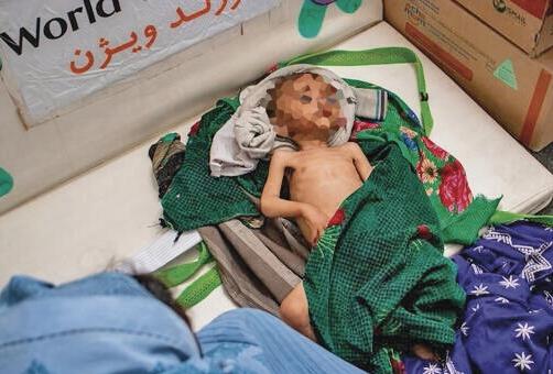 Un niño con desnutrición aguda severa en una clínica en el asentamiento de desplazados internos Sabz-e-Shark en Herat. Un niño con desnutrición aguda severa en una clínica en el asentamiento de desplazados internos Sabz-e-Shark en Herat.