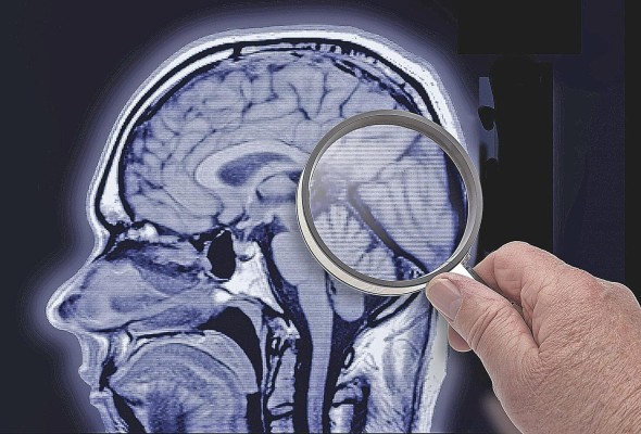 La demencia es un síndrome que implica el deterioro de la memoria, el intelecto, el comportamiento y la capacidad para realizar actividades La demencia es un síndrome que implica el deterioro de la memoria, el intelecto, el comportamiento y la capacidad para realizar actividades