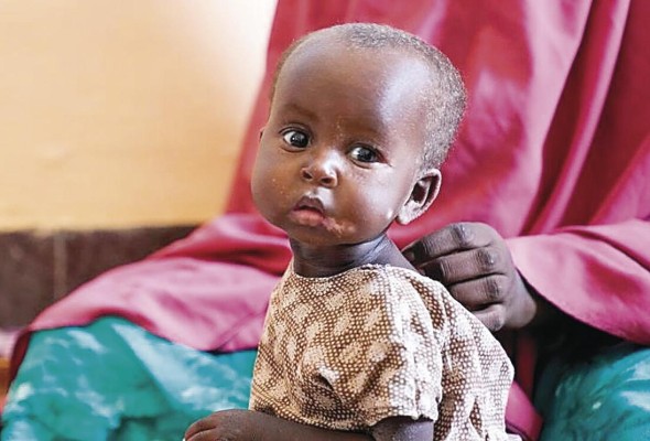 Marwo, una niña de 10 meses sentada con su madre en el Banadir Hospital en Mogadishu, Somalia , donde entró con desnutrición severa. Marwo, una niña de 10 meses sentada con su madre en el Banadir Hospital en Mogadishu, Somalia , donde entró con desnutrición severa.