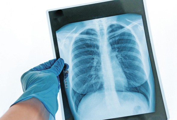La formación de cicatrices relacionadas a la fibrosis pulmonar puede deberse a diversos factores, entre ellos la covid-19. La formación de cicatrices relacionadas a la fibrosis pulmonar puede deberse a diversos factores, entre ellos la covid-19.