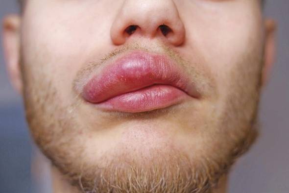 Angioedema hereditario: pacientes contrarreloj y sin medicamentos Angioedema hereditario: pacientes contrarreloj y sin medicamentos