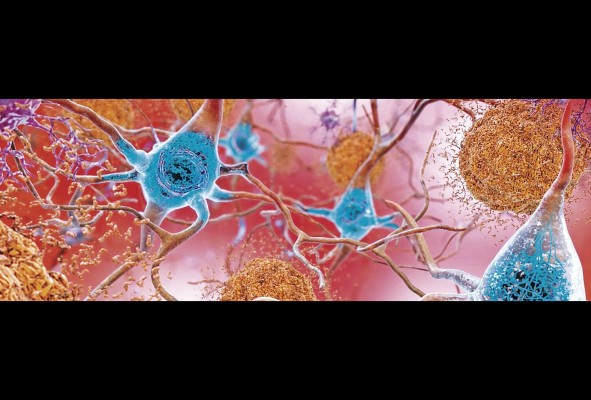 Las causas que originan la enfermedad de Alzheimer no han sido definidas completamente por la comunidad médica. Las causas que originan la enfermedad de Alzheimer no han sido definidas completamente por la comunidad médica.