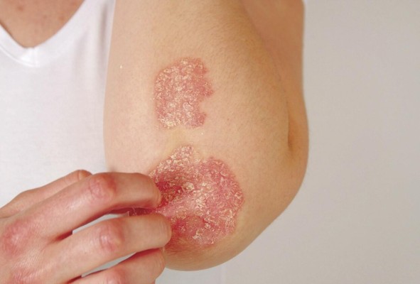La psoriasis es una enfermedad, del sistema inmune que puede ser hereditaria más no contagiosa. La psoriasis es una enfermedad, del sistema inmune que puede ser hereditaria más no contagiosa.