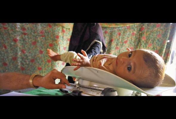 La baja talla infantil es uno de los efectos de la desnutrición crónica en los niños. La baja talla infantil es uno de los efectos de la desnutrición crónica en los niños.