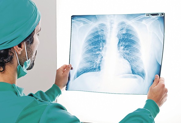 El cáncer de pulmón se mantiene como la tercera causa de incidencia y como la primera causa de mortalidad por cáncer en América Latina y el Caribe. El cáncer de pulmón se mantiene como la tercera causa de incidencia y como la primera causa de mortalidad por cáncer en América Latina y el Caribe.