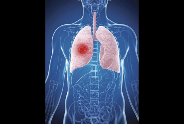 Según la OMS solo en el año 2020 se diagnosticaron 2.21 millones de personas con cáncer de pulmón, a nivel global. Según la OMS solo en el año 2020 se diagnosticaron 2.21 millones de personas con cáncer de pulmón, a nivel global.