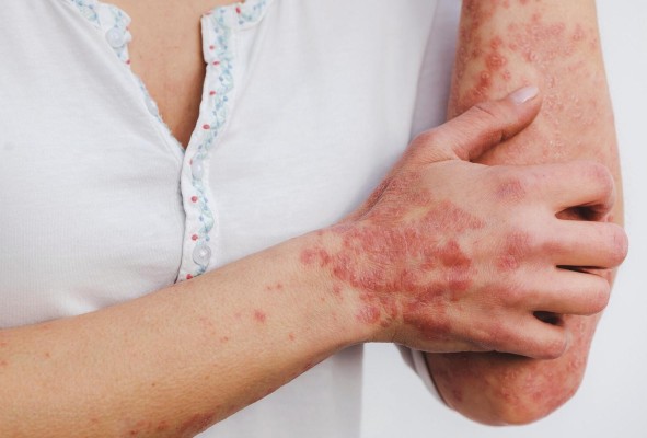 Según sus características y áreas de afectación en el cuerpo humano, se pueden identificar diversos tipos de psoriasis. Según sus características y áreas de afectación en el cuerpo humano, se pueden identificar diversos tipos de psoriasis.