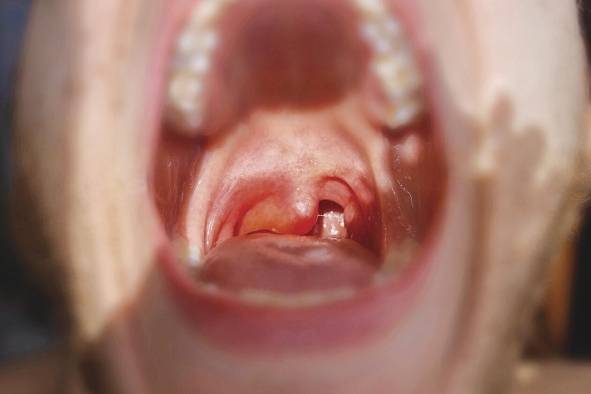 Angioedema hereditario: pacientes contrarreloj y sin medicamentos Angioedema hereditario: pacientes contrarreloj y sin medicamentos