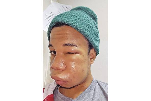 Angioedema hereditario: pacientes contrarreloj y sin medicamentos Angioedema hereditario: pacientes contrarreloj y sin medicamentos