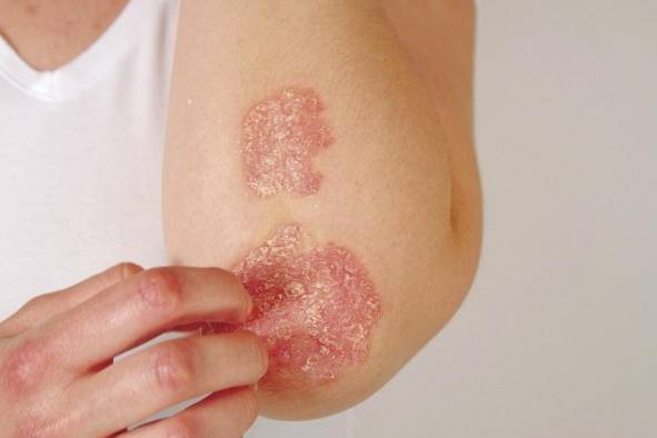 La psoriasis es una enfermedad, del sistema inmune que puede ser hereditaria más no contagiosa. La psoriasis es una enfermedad, del sistema inmune que puede ser hereditaria más no contagiosa.