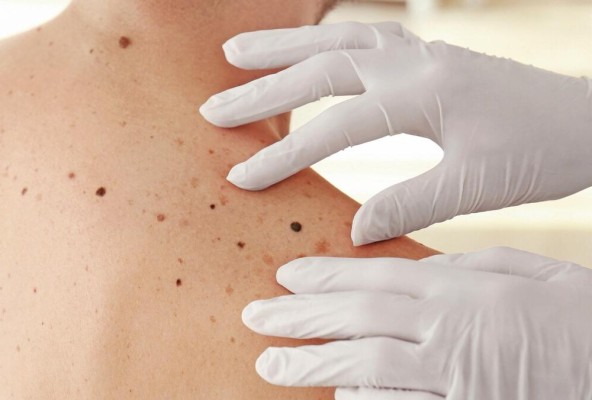 El cáncer de piel es una de las neoplasias más comunes; en algunos países ocupa el primer lugar en frecuencia. El cáncer de piel es una de las neoplasias más comunes; en algunos países ocupa el primer lugar en frecuencia.