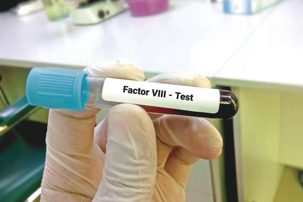 La hemofilia se diagnostica mediante pruebas de coagulación que establecen la cantidad de factor VIII o IX presente en la sangre. La hemofilia se diagnostica mediante pruebas de coagulación que establecen la cantidad de factor VIII o IX presente en la sangre.