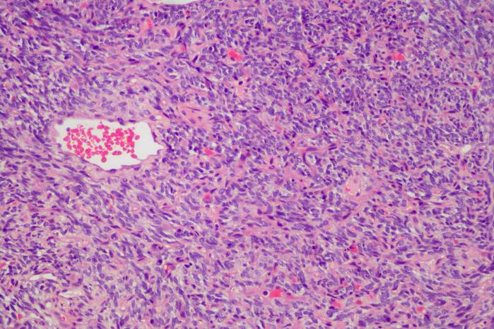 Sarcoma de tejidos blandos. Sarcoma de tejidos blandos.