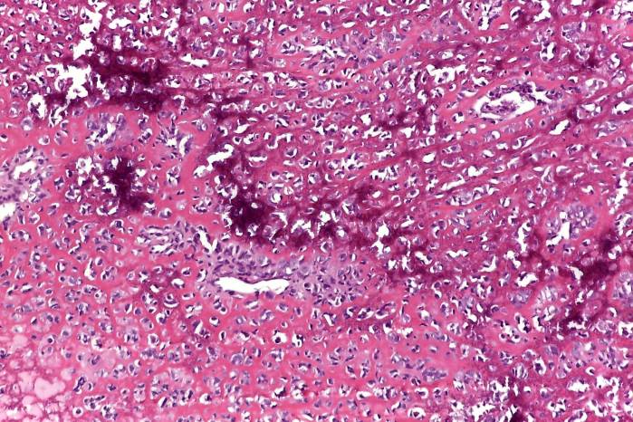 Microfotografía de un sarcoma óseo. Microfotografía de un sarcoma óseo.