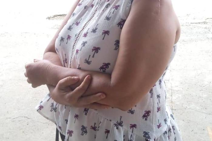 Berta Alicia Castillo Domínguez, sufrió una lesión permanente en uno de sus brazos. Berta Alicia Castillo Domínguez, sufrió una lesión permanente en uno de sus brazos.