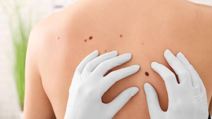 Las muertes causadas por cáncer de piel en Panamá representan un 0,32% de todos los decesos. Las muertes causadas por cáncer de piel en Panamá representan un 0,32% de todos los decesos.