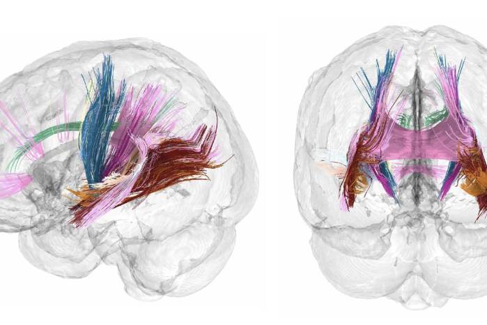 El volumen de materia gris cortical se reduce conforme avanza un embarazo. Los colores más oscuros indican las regiones que más reducen el volumen de materia gris durante la gestación. El volumen de materia gris cortical se reduce conforme avanza un embarazo. Los colores más oscuros indican las regiones que más reducen el volumen de materia gris durante la gestación.
