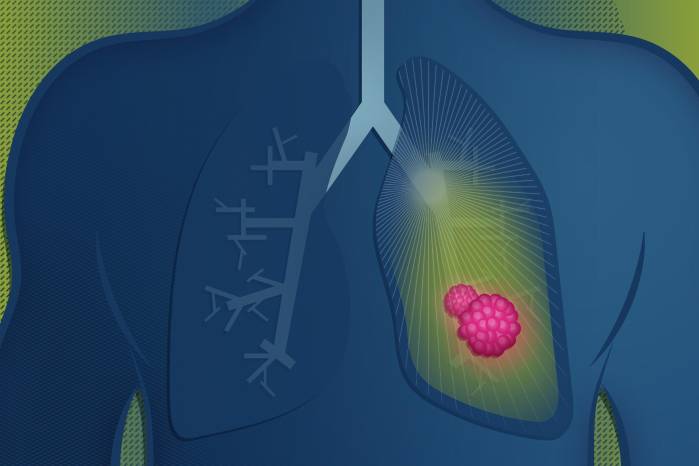 Detectar a tiempo el cáncer de pulmón puede cambiar el curso de la enfermedad.