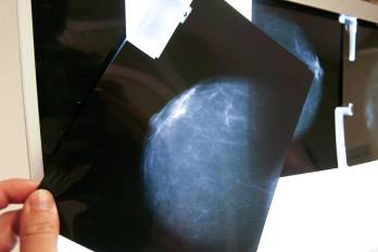 La detección temprana es clave para combatir el cáncer de mama.