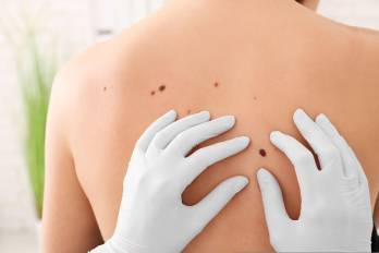 Las muertes causadas por cáncer de piel en Panamá representan un 0,32% de todos los decesos.