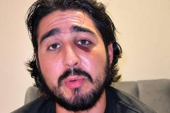 Captura de pantalla del creador de contenido mexicano Patricio Ramírez, quien narró y mostró las lesiones sufridas en el rostro tras la agresión el pasado 15 de agosto en un hostal de San Felipe.