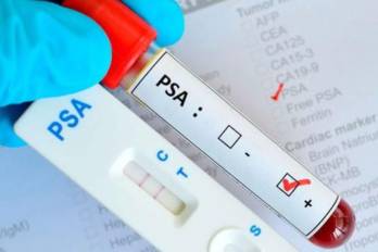 El Minsa despeja dudas sobre el PSA y el cáncer de próstata