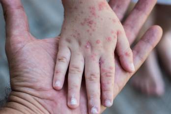 El Ministerio de Salud intensifica vigilancia por riesgo de sarampión