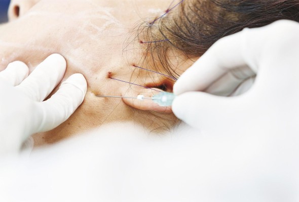Según los dermatólogos, cada piel admite un tipo de hilo determinado y, a su vez, cada hilo tiene una función específica.