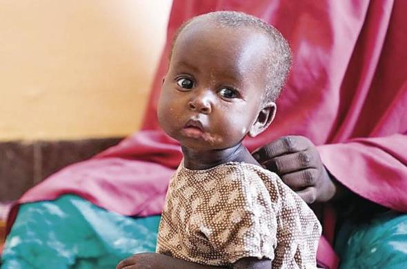 Marwo, una niña de 10 meses sentada con su madre en el Banadir Hospital en Mogadishu, Somalia , donde entró con desnutrición severa.