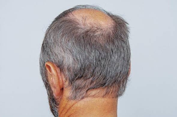 La alopecia se da en hombres a partir de los 50 años.