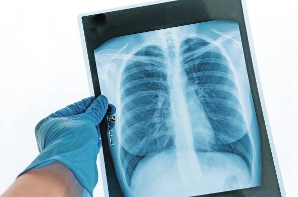 La formación de cicatrices relacionadas a la fibrosis pulmonar puede deberse a diversos factores, entre ellos la covid-19.