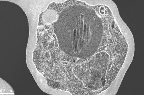 Microscopía en blanco y negro de un eritrocito infectado con el parásito 'P. falciparum' (gris más claro). En el parásito se ve la vacuola digestiva con el cristal de hemozoína adentro.