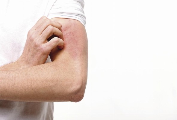 Erupciones dolorosas es uno de los síntomas de la dermatitis atópica.