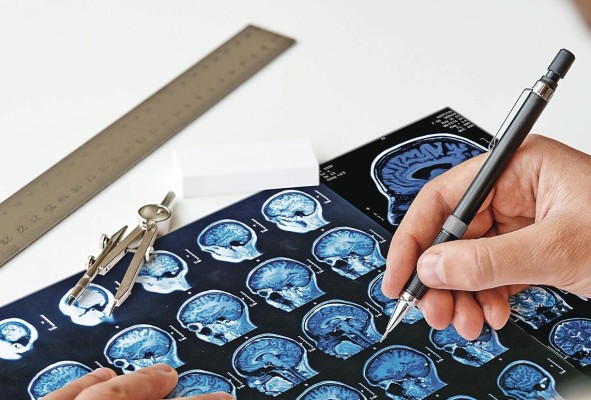 Los investigadores aún buscan un tratamiento efectivo para la enfermedad.