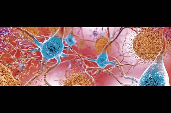 Las causas que originan la enfermedad de Alzheimer no han sido definidas completamente por la comunidad médica.