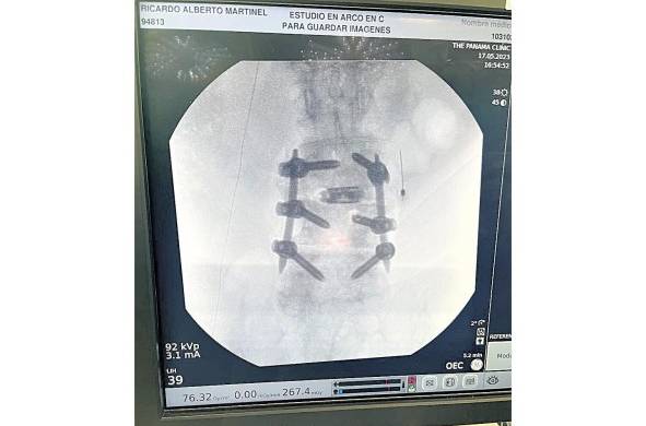 Radiografía publicada en la cuenta de Twitter del expresidente Ricardo Martinlli del reemplazo de discos durante la cirugía de columna