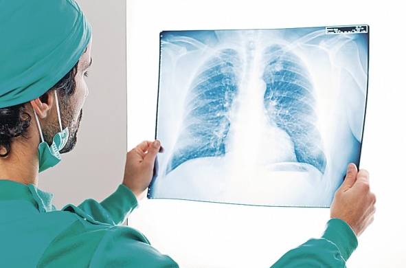 El cáncer de pulmón se mantiene como la tercera causa de incidencia y como la primera causa de mortalidad por cáncer en América Latina y el Caribe.