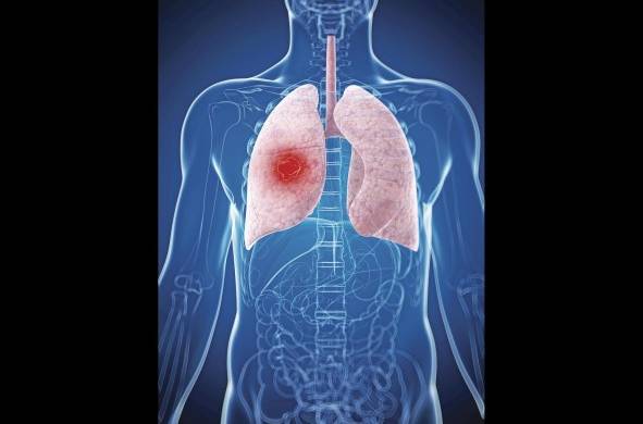 Según la OMS solo en el año 2020 se diagnosticaron 2.21 millones de personas con cáncer de pulmón, a nivel global.
