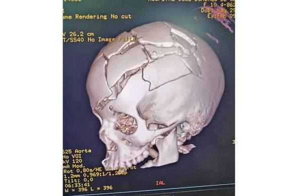 Imagen del cráneo de la niña.