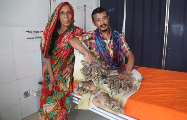 Abul Bajandar, el bangladesí que sufre una rara enfermedad genética por la que es conocido como el hombre árbol.