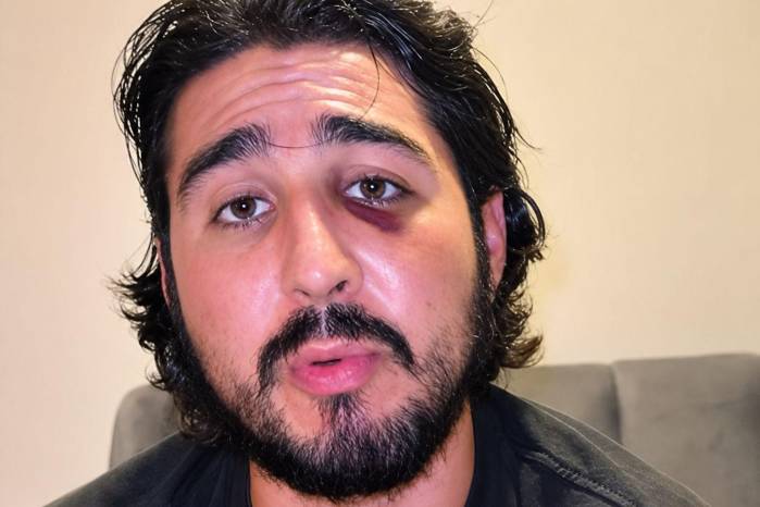 Captura de pantalla del creador de contenido mexicano Patricio Ramírez, quien narró y mostró las lesiones sufridas en el rostro tras la agresión el pasado 15 de agosto en un hostal de San Felipe.