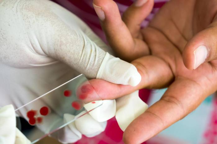 Los laboratorios regionales del Minsa avanzan con las pruebas de sangre ante el aumento de cuadros febriles por leishmaniasis.