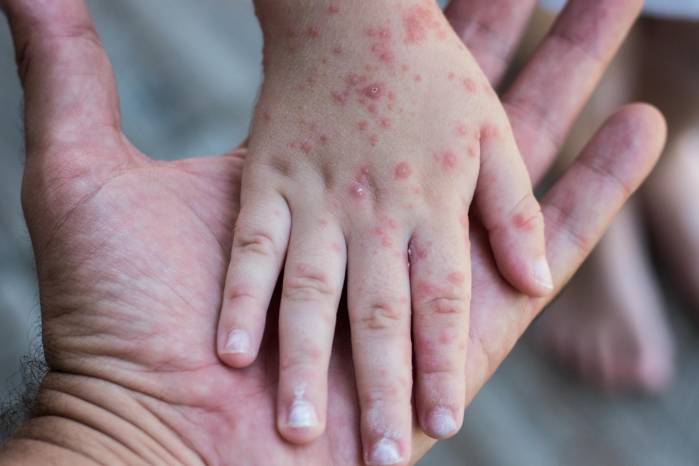 El Ministerio de Salud intensifica vigilancia por riesgo de sarampión