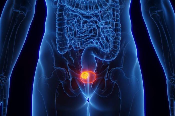 Ilustración 3D de un tumor en la vejiga.