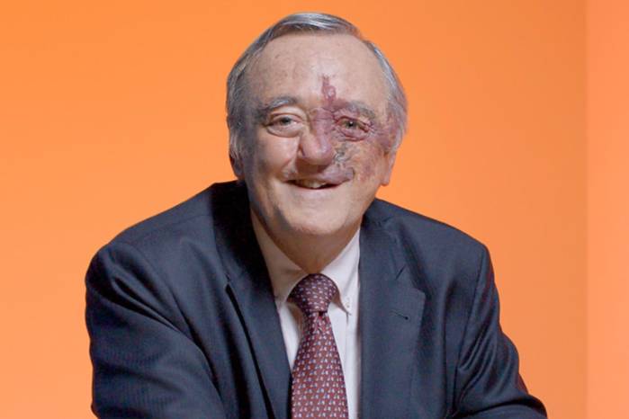 Un equipo de científicos españoles, liderado por el oncólogo Mariano Barbacid, ha conseguido un avance sin precedentes en la lucha contra el cáncer de páncreas.