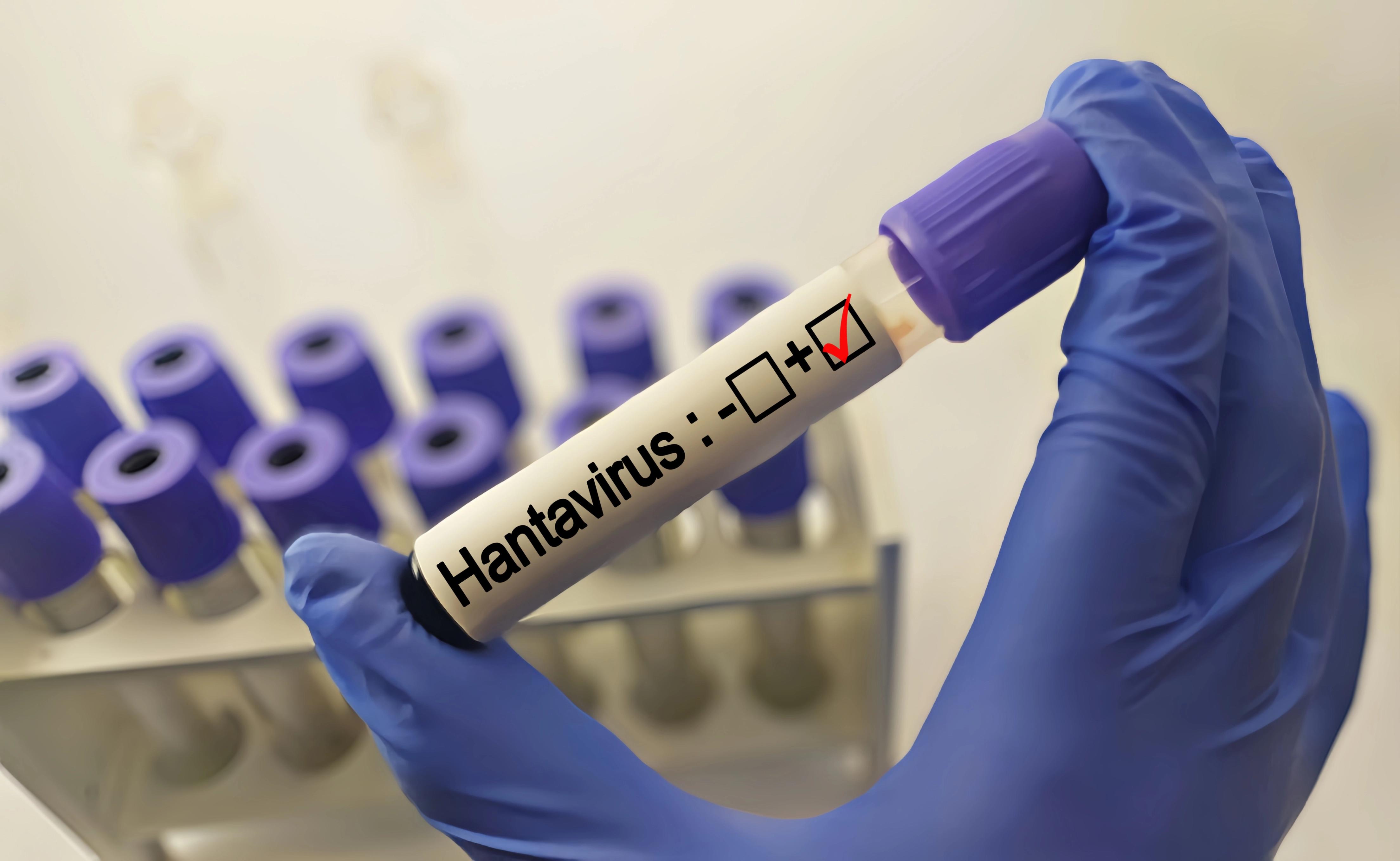 Minsa confirma caso de hantavirus en Guararé y descarta nexo con sismo